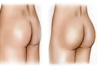 Buttock-lipofilling-results-Tunisia